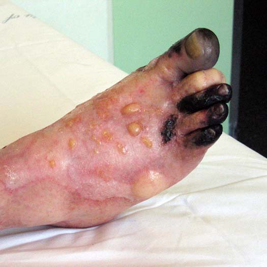Gangrene Foot
